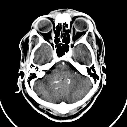 File:Cerebral venous angioma (Radiopaedia 69959-79977 B 10).jpg