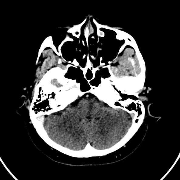 File:Cerebral venous hemorrhagic infarct from venous sinus thrombosis (Radiopaedia 55433-61883 Axial C+ delayed 118).jpg