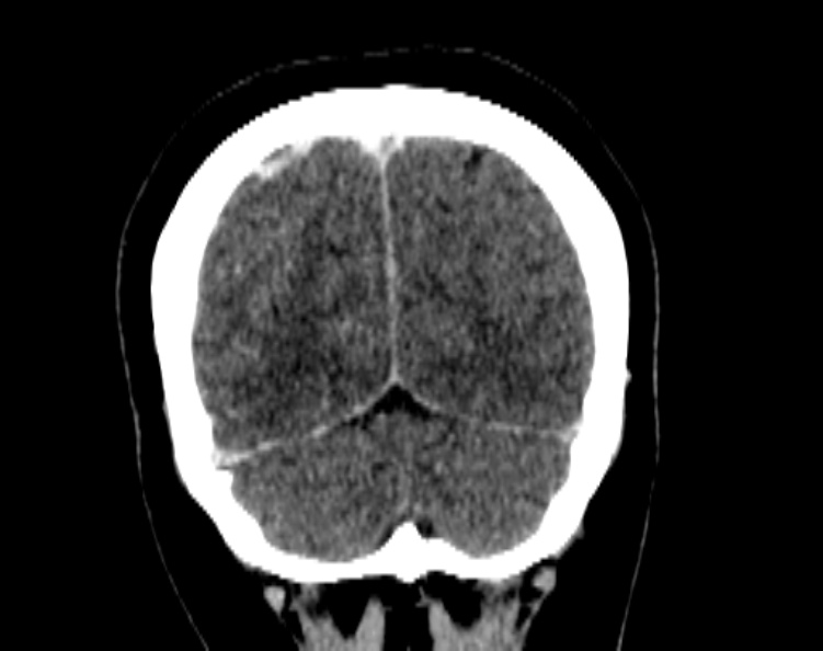 Cerebral venous hemorrhagic infarct from venous sinus thrombosis (Radiopaedia 55433-61883 Coronal C+ delayed 51).jpg