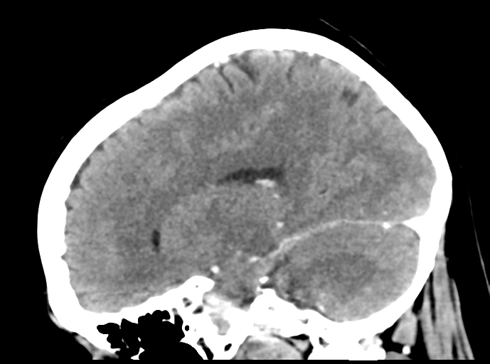 Cerebral venous hemorrhagic infarction (Radiopaedia 57576-64538 Sagittal C+ 32).png