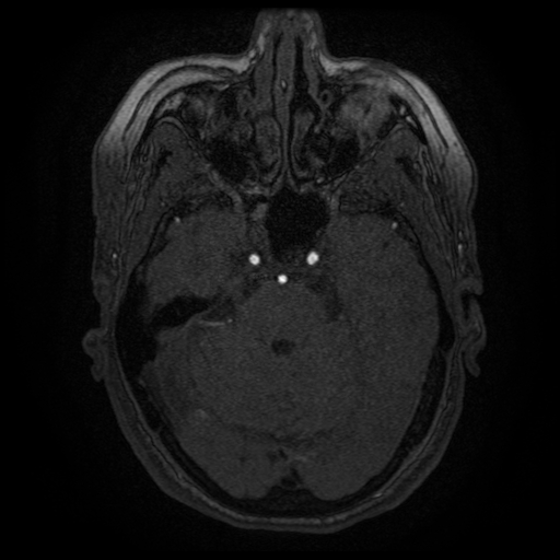 Cerebral venous infarction (Radiopaedia 25109-25363 MRA 16).jpg