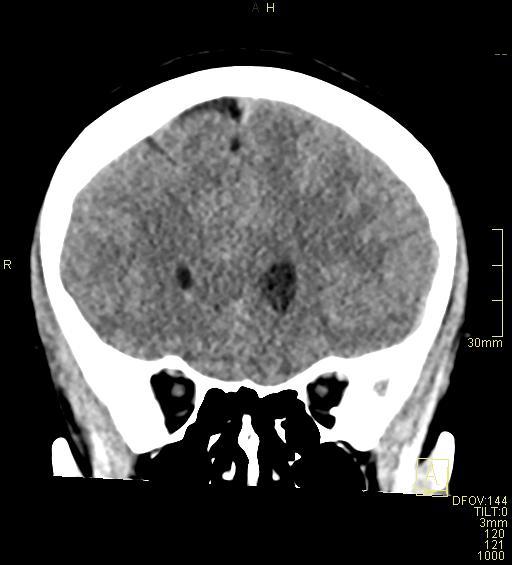 File:Cerebral venous sinus thrombosis (Radiopaedia 91329-108965 Coronal non-contrast 17).jpg