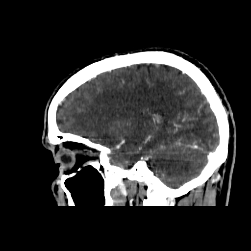 File:Cerebral venous thrombosis (CVT) (Radiopaedia 77524-89685 Sagittal CTV 30).jpg