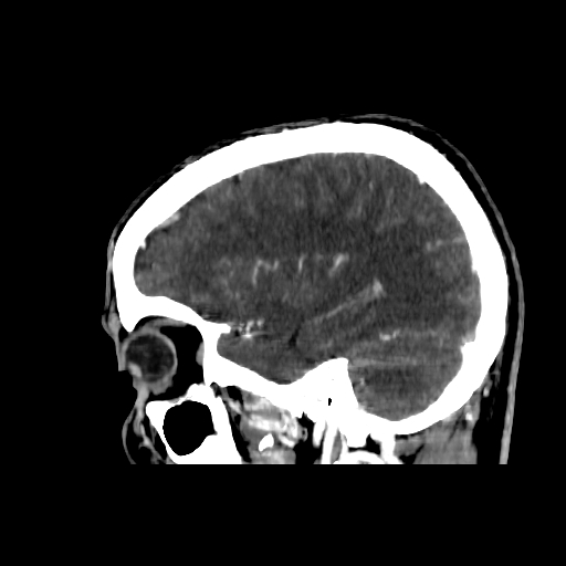 File:Cerebral venous thrombosis (CVT) (Radiopaedia 77524-89685 Sagittal CTV 34).jpg