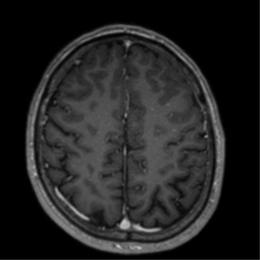 Cerebral venous thrombosis (Radiopaedia 38392-40469 Axial T1 C+ 59).png