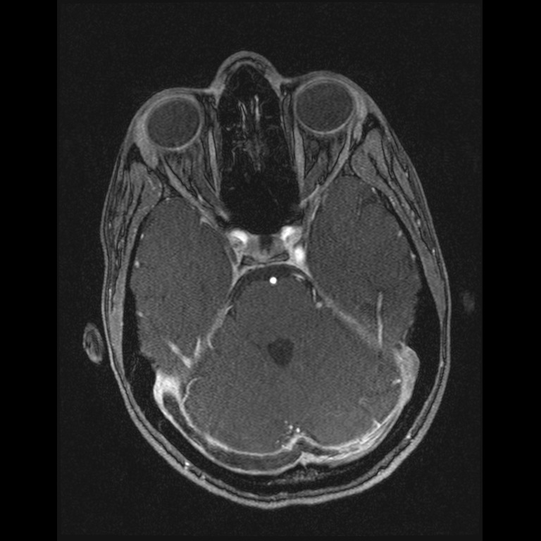 Cerebral venous thrombosis (Radiopaedia 45678-49854 Axial MRV 21).jpg