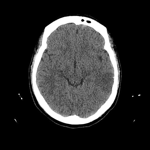 Cerebral venous thrombosis with venous hemorrhagic infarct (Radiopaedia 90354-107660 Axial non-contrast 22).jpg