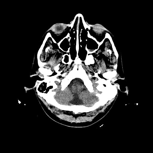 Cerebral venous thrombosis with venous hemorrhagic infarct (Radiopaedia 90354-107660 Axial non-contrast 8).jpg