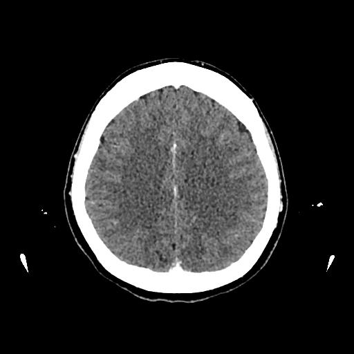 Cerebral venous thrombosis with venous hemorrhagic infarct (Radiopaedia 90354-107660 Axial with contrast 116).jpg