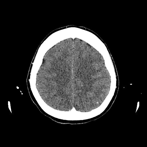 File:Cerebral venous thrombosis with venous hemorrhagic infarct (Radiopaedia 90354-107660 Axial with contrast 122).jpg