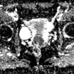 File:Cervical adenocarcinoma (Radiopaedia 65011-73985 Axial ADC 15).jpg