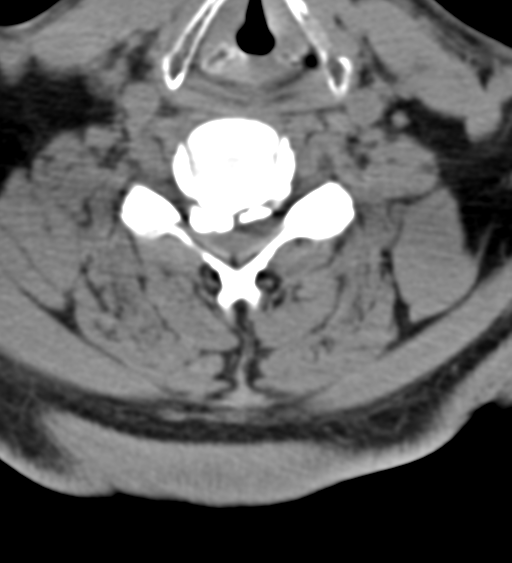 Cervical canal stenosis due to ossification of the posterior longitudinal ligament (Radiopaedia 47260-51823 Axial non-contrast 38).png