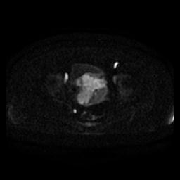 File:Cervical carcinoma (Radiopaedia 67644-77047 Axial DWI 13).jpg