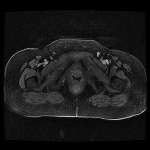 Cervical carcinoma (Radiopaedia 70924-81132 Axial T1 C+ fat sat 113).jpg