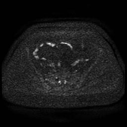 Cervical carcinoma (Radiopaedia 85405-101028 Axial DWI 57).jpg