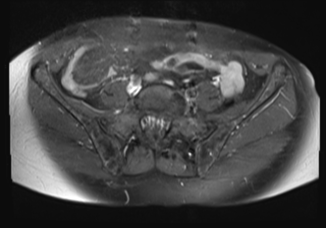 File:Cervical carcinoma (Radiopaedia 88312-104943 Axial T1 C+ fat sat 4).jpg