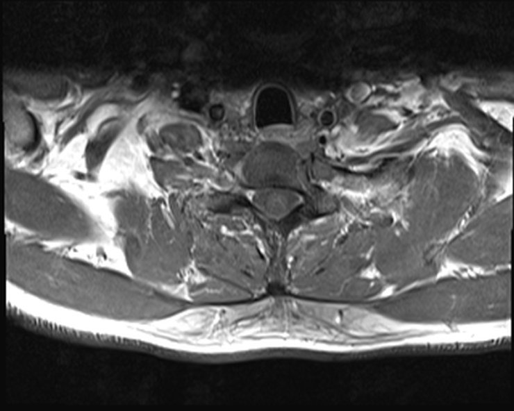 File:Cervical disc extrusion (Radiopaedia 53950-60077 Axial T1 C+ fat sat 26).jpg