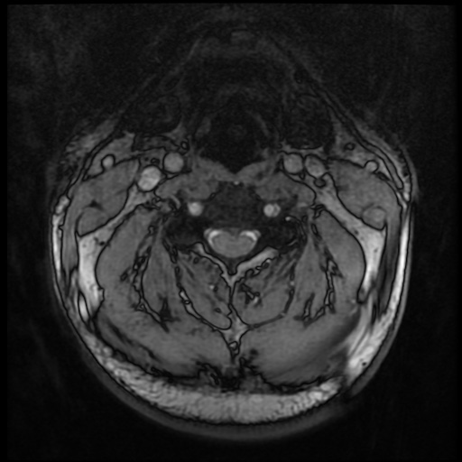 Cervical disc extrusion (Radiopaedia 59074-66364 G 29).jpg