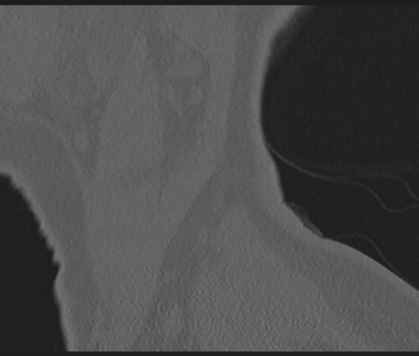 File:Cervical disc replacement (Radiopaedia 44025-47541 Sagittal bone window 81).png