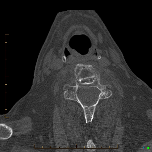 Cervical spine fracture - ankylosing spondylitis (Radiopaedia 76835-88706 Axial bone window 145).jpg