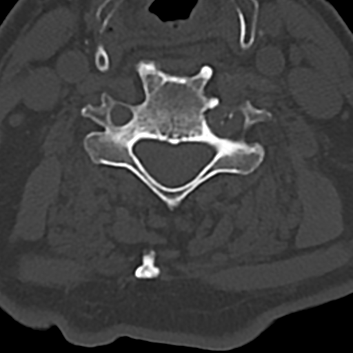 File:Cervical spine fracture - chalk stick (Radiopaedia 39116-41323 Axial bone window 53).png