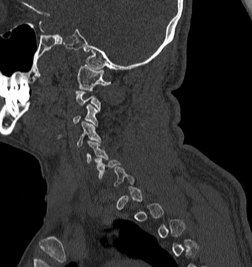 Cervical spine trauma with tear drop fracture and perched facet joint (Radiopaedia 53989-60127 Sagittal bone window 136).jpg