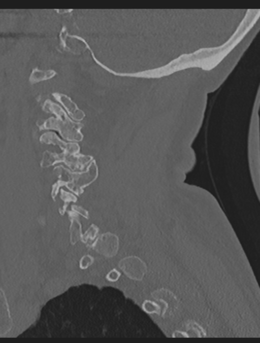 Cervical spondylolysis (Radiopaedia 49616-54811 Sagittal bone window 20).png