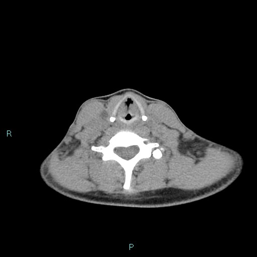 Cervical thymic cyst (Radiopaedia 88632-105335 Axial non-contrast 48).jpg