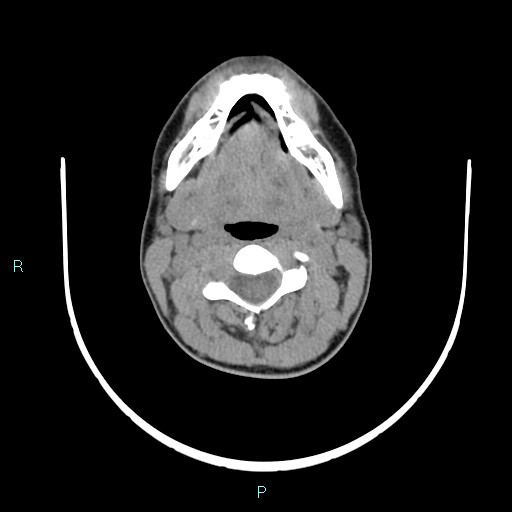 File:Cervical thymic cyst (Radiopaedia 88632-105335 Axial non-contrast 76).jpg