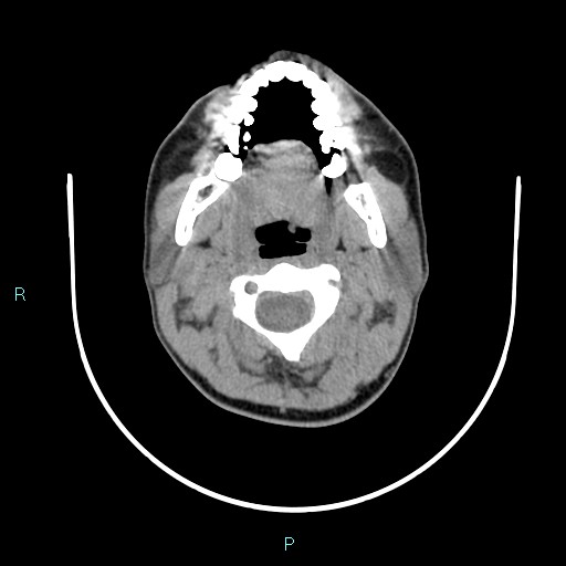 File:Cervical thymic cyst (Radiopaedia 88632-105335 Axial non-contrast 86).jpg
