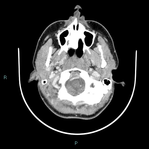 Cervical thymic cyst (Radiopaedia 88632-105335 C 100).jpg