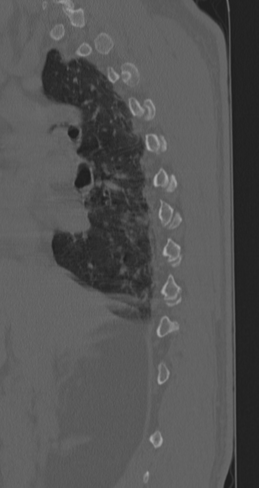 Chance fracture (Radiopaedia 33854-35020 Sagittal bone window 64).png