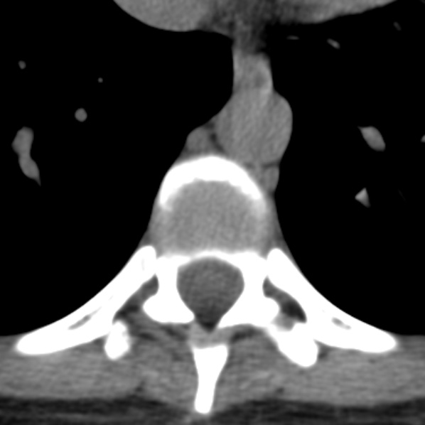 File:Chance fracture (Radiopaedia 36521-38081 Axial non-contrast 25).jpg
