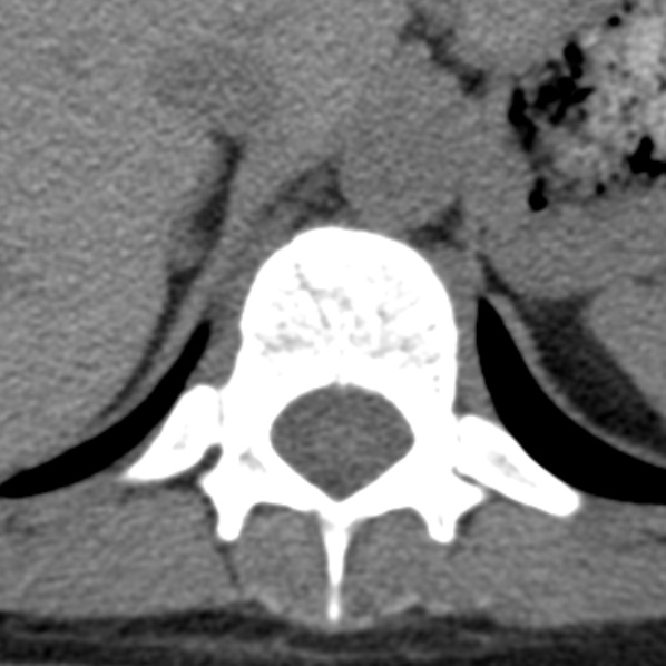 Chance fracture (Radiopaedia 36521-38081 Axial non-contrast 54).jpg