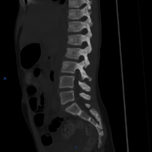 File:Chance fracture with duodenal and pancreatic lacerations (Radiopaedia 43477-50042 Sagittal bone window 15).jpg