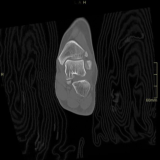 Chaput tubercle fracture (Radiopaedia 80319-93956 Coronal non-contrast 35).jpg