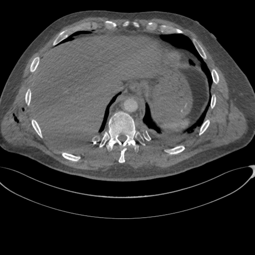 Chest multitrauma - aortic injury (Radiopaedia 34708-36147 A 250).png