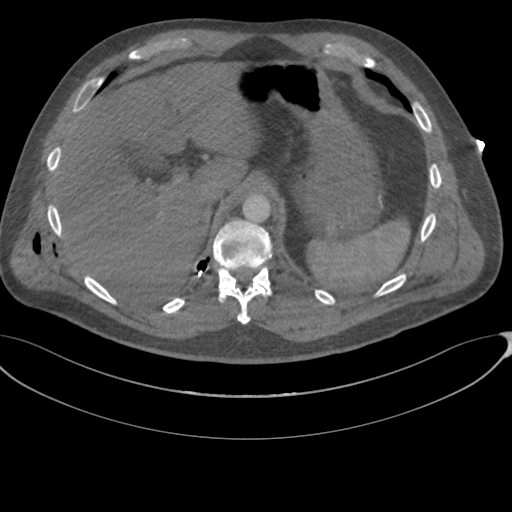 File:Chest multitrauma - aortic injury (Radiopaedia 34708-36147 A 278).png