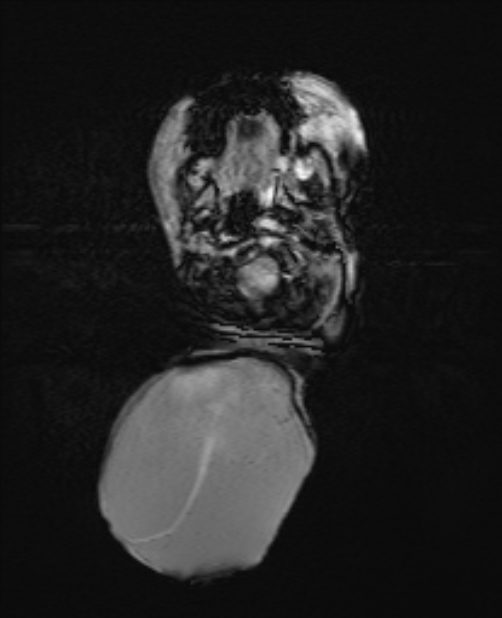 Chiari III malformation with occipital encephalocele (Radiopaedia 79446-92559 Axial SWI 19).jpg