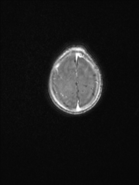 Chiari III malformation with occipital encephalocele (Radiopaedia 79446-92559 Axial T1 C+ mpr 74).jpg