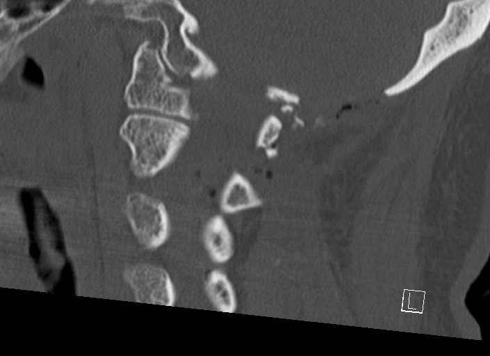 Chiari I malformation with a symptomatic syrinx of the posterolateral medulla oblongata (Radiopaedia 42573-45707 A 24).jpg