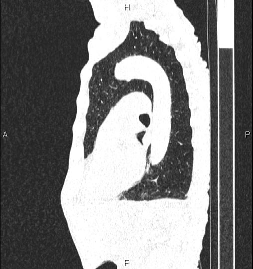 Chilaiditi sign (Radiopaedia 88839-105611 Sagittal lung window 62).jpg