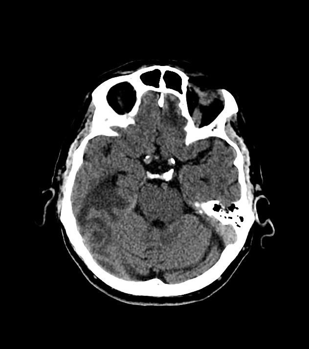 Cholangiocarcinoma with cerebral metastases (Radiopaedia 83519-98628 Axial non-contrast 26).jpg