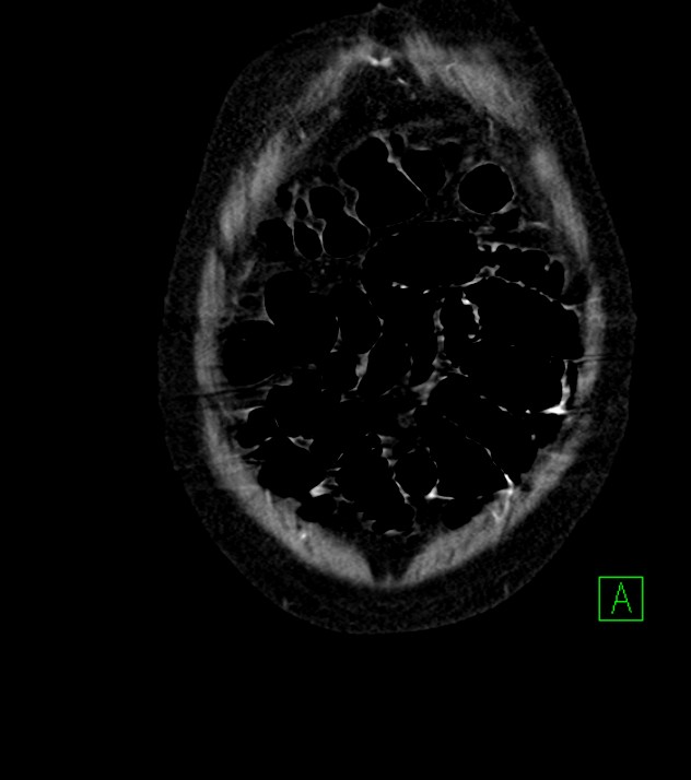 Cholangiocarcinoma with cerebral metastases (Radiopaedia 83519-98629 E 10).jpg
