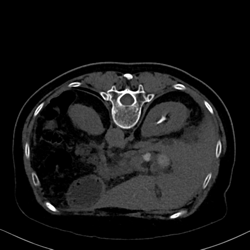File:Cholecystitis - obstructive choledocholitiasis (CT intravenous cholangiography) (Radiopaedia 43966-47479 Axial 5).png