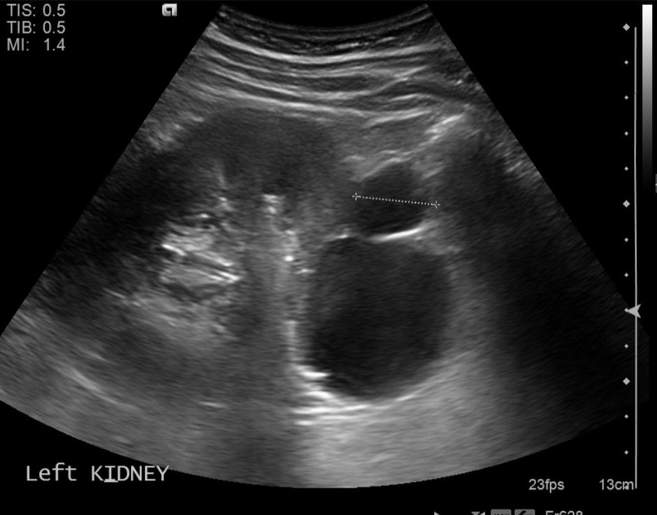 File:Cholecystitis - perforated gallbladder (Radiopaedia 57038-63913 A 24).jpg