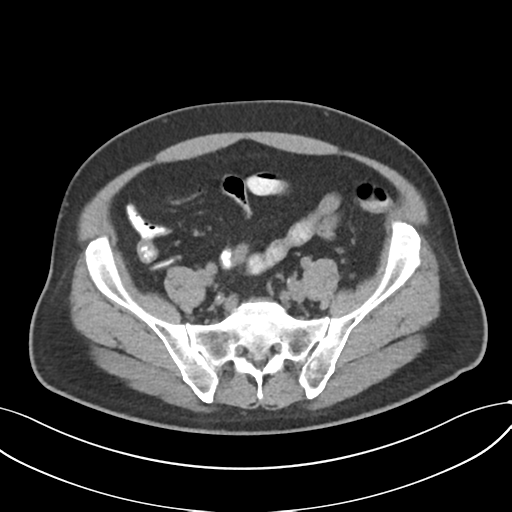 Cholecystitis with focal perforation and hepatic abscess (Radiopaedia 37189-38945 Axial non-contrast 64).png