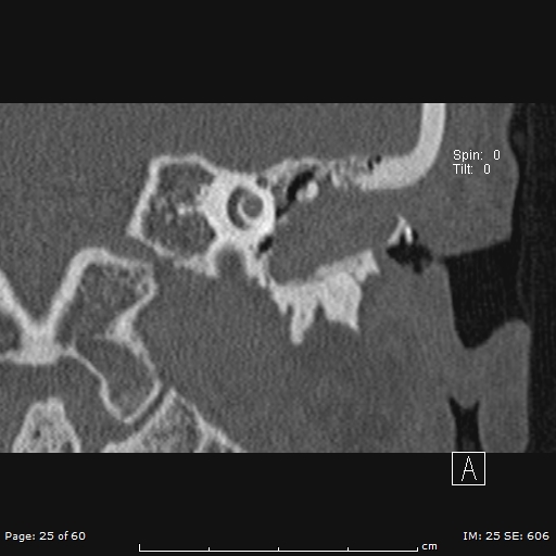 Cholesteatoma - external auditory canal (Radiopaedia 88452-105096 Coronal bone window 25).jpg