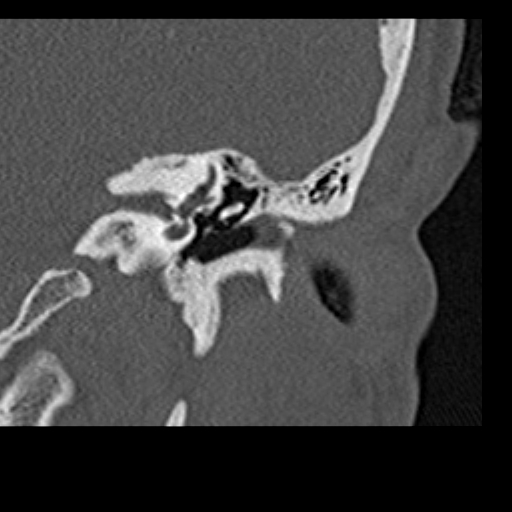 File:Cholesteatoma of the external ear (Radiopaedia 16540-16225 Coronal bone window 11).jpg