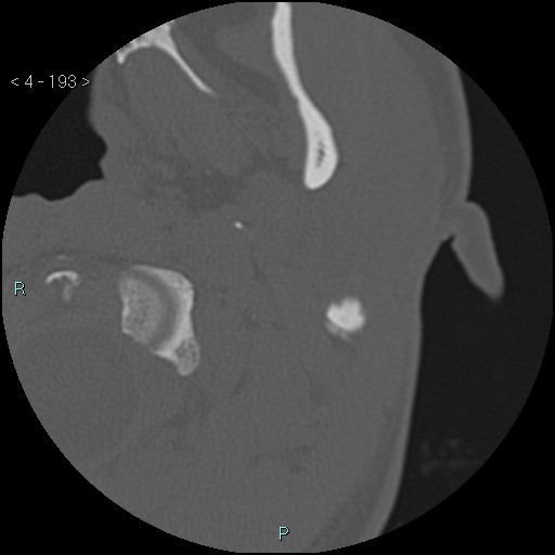 Cholesterol granuloma of the petrous apex (Radiopaedia 64358-73141 Axial bone window 93).jpg